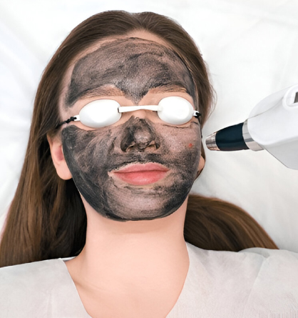 Carbon Peel