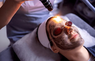 Carbon Peel