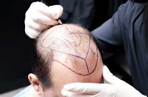 Hair PRP