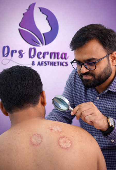 Tinea Treatment 1